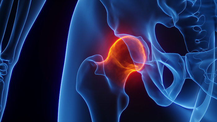 Inflamed hip joint, illustration Inflamed hip joint, illustration., by SEBASTIAN KAULITZKI SCIENCE PHOTO LIBRARY