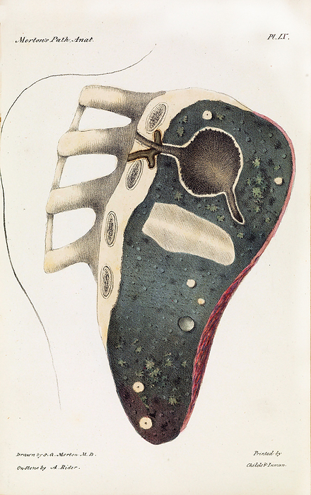 Lung infected with tuberculosis, 19th century illustration Illustration of the superior lobe of the right lung infected with tuberculosis. Tuberculosis  TB  is a bacterial infection that usually affects the lungs but can affect other body tissues. It causes inflammation and scarring in the lungs, leading to tissue damage. Here, the lung s blue grey colour is indicative of pneumonia. It also contains nodular lesions  yellow, grey  and a large cavity at the top  circular, grey . Commonly called consumption in the 1800s, TB was a widespread cause of death during this period before the invention of vaccines  1921  and antibiotics  1943 . Published in  Illustrations of pulmonary consumption  by Samuel George Morton in 1834., by WELLCOME IMAGES SCIENCE PHOTO LIBRARY
