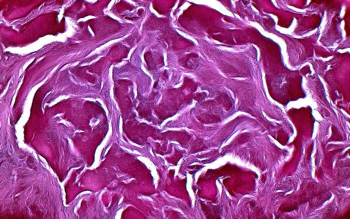 Corpus amylaceous, light micrograph Light micrograph of a large corpus amylaceous  pleural: corpora amylacea  in a prostate. Corpora amylacea are normal structures found in human prostate glands. They often appear to have cracks in prepared histologic tissue sections. The cracks in this close up of a corpus amylaceous are the irregular white lines in between the pink purple substance which makes up the corpus amylaceous itself. Haematoxylin and eosin stained tissue section. Magnification: x400 when printed at 10cm wide., by ZIAD M. EL ZAATARI SCIENCE PHOTO LIBRARY