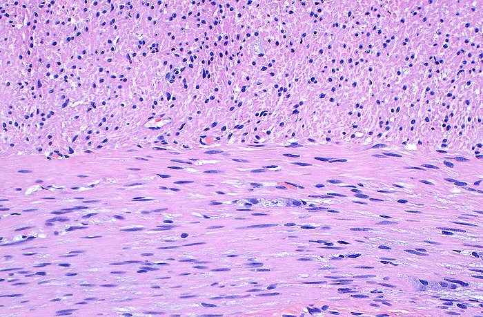 Appendix intestinal smooth muscle layers, light micrograph Light micrograph of the smooth muscle wall of a human appendix. The smooth muscle is made up of individual cells that are arranged in two perpendicular layers. The outer layer  top half of image  is cut in cross section and therefore we see its nuclei as circles  dark blue dots  surrounded by cytoplasm  pink . The inner layer  lower half of image  is cut parallel to the direction of the smooth muscle cells, so we see their nuclei as thin lines  dark blue  parallel to its long cytoplasm  pink  fibres. Haematoxylin and eosin stained tissue section. Magnification: x200 when printed at 10 cm., by ZIAD M. EL ZAATARI SCIENCE PHOTO LIBRARY