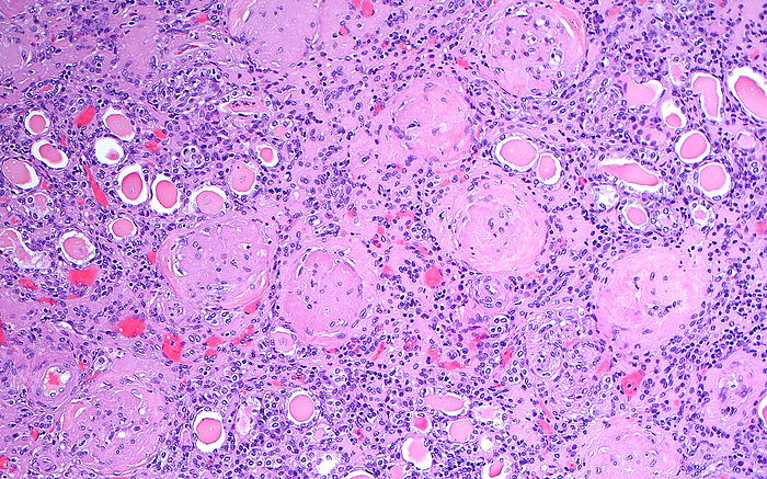 Chronic kidney disease, light micrograph Light micrograph of a nephrosclerosis, the process that occurs in a chronically damaged kidney. The kidney tubules  small pink circles  are atrophic and surrounded by chronic inflammatory cells  many small blue dots . The glomeruli  larger circular structures  are sclerotic and have been overtaken by fibrous  pink  deposits. Haematoxylin and eosin stained section. Magnification: x100 when printed at 10 cm., by ZIAD M. EL ZAATARI SCIENCE PHOTO LIBRARY