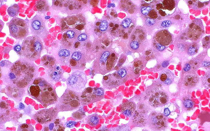 Haemosiderin macrophages, light micrograph Light micrograph of haemosiderin pigment  dark brown clumps  that has been ingested by macrophages  pink circles , a type of immune cell. The haemosiderin originates from the metabolism of haemoglobin from extravasated red blood cells  bright red . Haematoxylin and eosin stained tissue section. Magnification: x600 when printed at 10cm wide., by ZIAD M. EL ZAATARI SCIENCE PHOTO LIBRARY