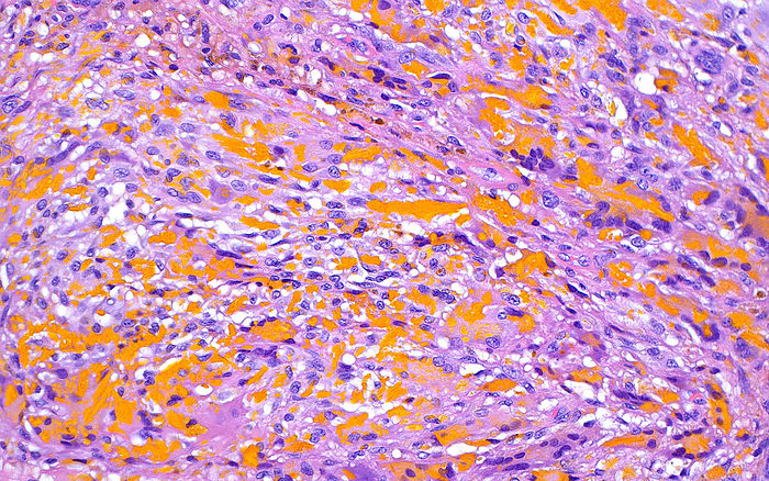 Haematoidin pigment, light micrograph Light micrograph of haematoidin pigment. This golden yellow brown pigment forms from the metabolism of haemoglobin from extravasated red blood cells, that is red blood cells that have spilled out of damaged blood vessels. Here, the haematoidin pigment is present admixed with inflammatory cells  light and dark purple blue . Haematoxylin and eosin stained tissue. Magnification: x200 when printed at 10cm wide., by ZIAD M. EL ZAATARI SCIENCE PHOTO LIBRARY