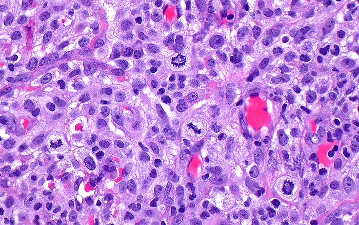 Bladder cancer, light micrograph Light micrograph of cells of invasive urothelial carcinoma  bladder cancer . The bladder cancer cells have rounded or oval nuclei  dark purple  interspersed with mitotic figures and small blood vessels  bright red . Haematoxylin and eosin stained tissue section. Magnification: x400 when printed at 10cm wide., by ZIAD M. EL ZAATARI SCIENCE PHOTO LIBRARY