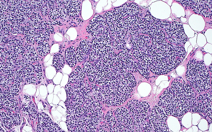 Parathyroid gland cells, light micrograph Light micrograph of cells of a parathyroid gland. There is adipose  fat  tissue, whose cells have large spaces  white  in between collections of parathyroid cells. The parathyroid cells are smaller and show round blue nuclei  many small blue dots . Interspersed fibrous tissue can also be seen  pink . Haematoxylin and eosin stained tissue section. Magnification: x100 when printed at 10cm wide., by ZIAD M. EL ZAATARI SCIENCE PHOTO LIBRARY
