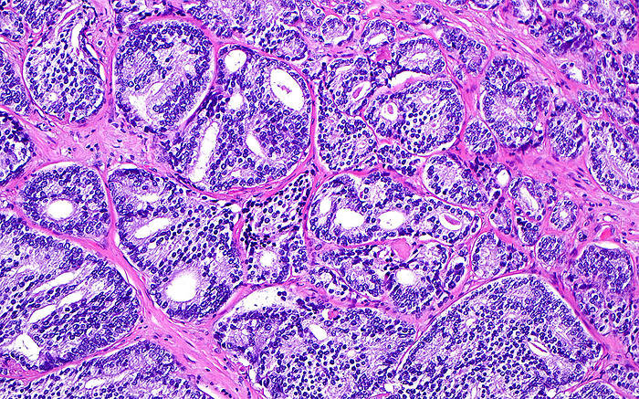 Prostate cancer cribriform pattern, light micrograph Light micrograph of prostate cancer glands. The prostate cancer cells form glandular structures  blue structures with roughly oval white spaces inside . This architecture of glands is known as cribriform. The glands are interspersed within the prostatic stroma  pink background in between cancer glands . Haematoxylin and eosin stained tissue section. Magnification: x100 when printed at 10cm wide., by ZIAD M. EL ZAATARI SCIENCE PHOTO LIBRARY