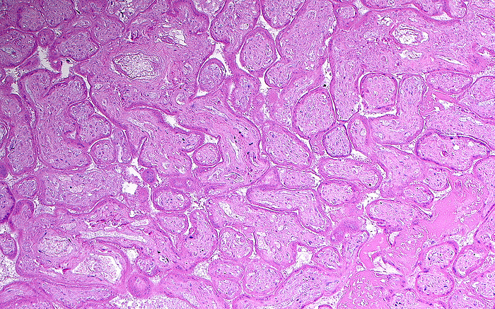 Placenta infarct, light micrograph Light micrograph of placental villi which have undergone infarction. The villi are the circular, elongated and branching pink structures occupying the full field of the image. Placental infarction is an insignificant finding when a small area of the placenta is affected. Larger areas of the placenta would be affected in frank disease processes. Haematoxylin and eosin stained tissue section. Magnification: x100 when printed at 10cm wide., by ZIAD M. EL ZAATARI SCIENCE PHOTO LIBRARY