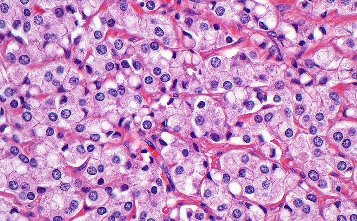 Prostate cancer, light micrograph Light micrograph of prostate cancer cells which have circular nuclei  blue circles  each surrounded by eosinophilic  pink  cytoplasm. Here, the prostate cancer cells form solid sheets of cells, considered a high grade type of pattern that carries a worse prognosis. Haematoxylin and eosin stained tissue section. Magnification: x400 when printed at 10cm wide., by ZIAD M. EL ZAATARI SCIENCE PHOTO LIBRARY
