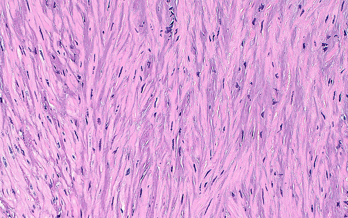 Smooth muscle in prostate, light micrograph Light micrograph of the smooth muscle stroma, or connective tissue, from a prostate gland. The smooth muscle cells have spindle, or elongated, nuclei  darkest short blue lines  and form intersecting fibres  long and pink vertically oriented streaks . Haematoxylin and eosin stained tissue section. Magnification: x200 when printed at 10cm wide., by ZIAD M. EL ZAATARI SCIENCE PHOTO LIBRARY
