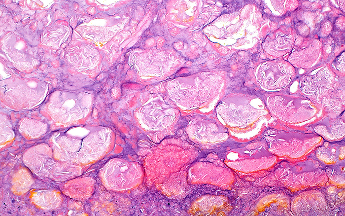 Saponification fat necrosis, light micrograph Light micrograph of fat necrosis around a pancreas. The fat cells have become necrotic  dead  due to the release of digestive enzymes from a damaged pancreas. This type of fat necrosis around a damaged pancreas is termed saponification type fat necrosis. Haematoxylin and eosin stained tissue section. Magnification: x200 when printed at 10cm wide., by ZIAD M. EL ZAATARI SCIENCE PHOTO LIBRARY