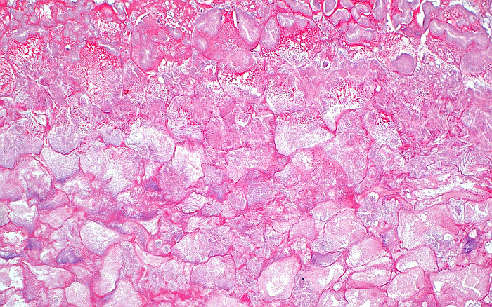 Saponification fat necrosis, light micrograph Light micrograph of fat necrosis around a pancreas. The fat cells have become necrotic  dead  due to the release of digestive enzymes from a damaged pancreas. This type of fat necrosis is termed saponification type fat necrosis. Haematoxylin and eosin stained tissue section. Magnification: x200 when printed at 10cm wide., by ZIAD M. EL ZAATARI SCIENCE PHOTO LIBRARY