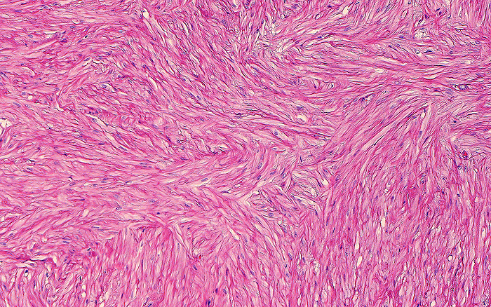 Smooth muscle in seminal vesicle, light micrograph Light micrograph of smooth muscle cells of a seminal vesicle. The seminal vesicles are organs adjacent to the human prostate and they secrete part of the fluid that makes up semen, the fluid which carries sperm. The wall of the seminal vesicles is made up of smooth muscle cells, which are the many elongated fibre like cells seen in this image. The smooth muscle cells are arranged in bundles that are haphazardly arranged and crisscross with each other. Haematoxylin and eosin stained tissue section. Magnification: x100 when printed at 10cm wide., by ZIAD M. EL ZAATARI SCIENCE PHOTO LIBRARY