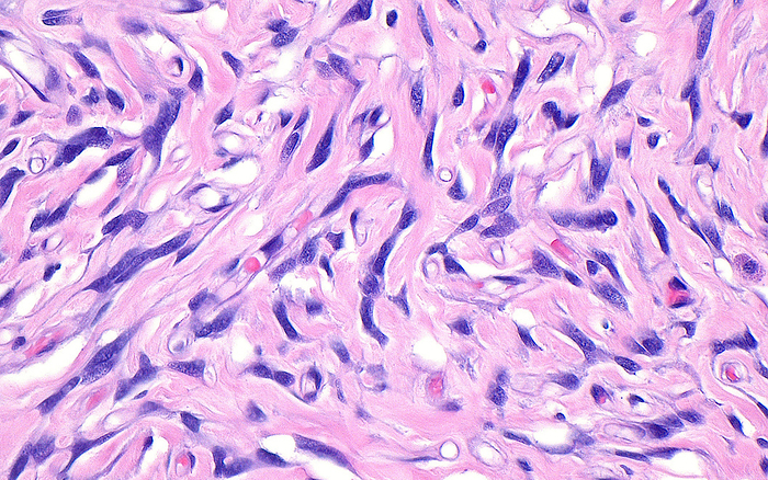 Solitary fibrous tumour, light micrograph Light micrograph of cells of a solitary fibrous tumour, a type of growth that can occur in the soft tissues of the body. The tumour cells have spindled nuclei  dark purple  and are present within variable amounts of collagen substance  pink . A few red blood cells in capillaries  bright red  are also seen in this image. Haematoxylin and eosin stained tissue section. Magnification: x400 when printed at 10cm wide., by ZIAD M. EL ZAATARI SCIENCE PHOTO LIBRARY