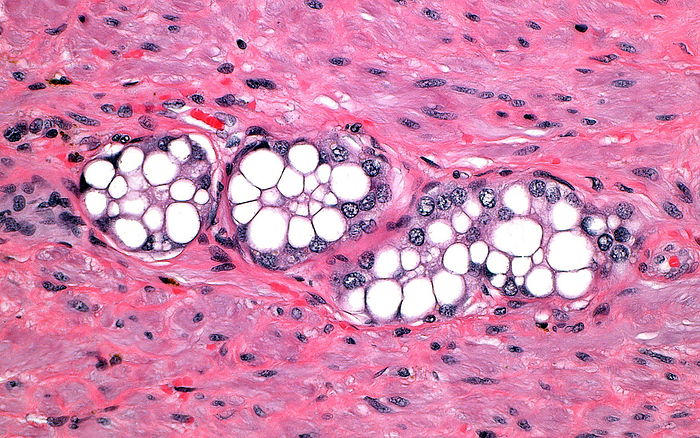 Prostate cancer vacuolated cells, light micrograph Light micrograph of prostate cancer cells  mid portion of image , which in this case contain numerous vacuoles  white circles . The vacuoles are contained in the cytoplasm alongside the cancer cell nuclei  dark blue circles . Around the prostate cancer cells is connective stromal tissue  pink to red . Haematoxylin and eosin stained tissue section. Magnification: x200 when printed at 10cm, by ZIAD M. EL ZAATARI SCIENCE PHOTO LIBRARY