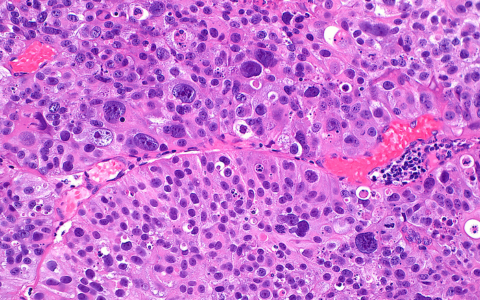 Bladder cancer, light micrograph Light micrograph of urothelial carcinoma  bladder cancer . The cancer cells occupy most of the field of view with occasional interspersed blood vessels  bright red . The cancer cell nuclei  round blue dots  are pleomorphic  variable in size  with smaller nuclei and some much larger nuclei present. Such variation in nuclear size is a feature of high grade cancer, which has a greater chance of behaving aggressively by invading locally or metastasis  distant spread . Haematoxylin and eosin stained tissue section. Magnification: x200 when printed at 10x., by ZIAD M. EL ZAATARI SCIENCE PHOTO LIBRARY