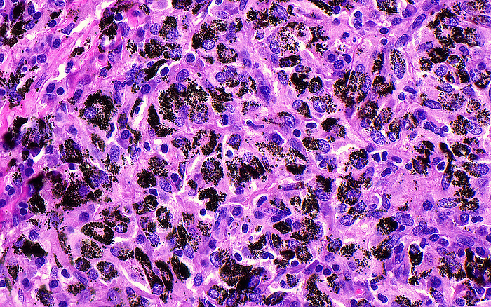 Anthracotic pigment, light micrograph Light micrograph of anthracotic pigment  black dots  accumulated in one of the draining lymph nodes of the lungs. The pigment is picked up by macrophage cells  pink and purple  that transport it through lymphatic channels to draining lymph nodes. Anthracotic pigment can accumulate in smokers or in urban residents who inhale dust and other substances from the air. Haematoxylin and eosin stained tissue section. Magnification: x400 when printed at 10 cm., by ZIAD M. EL ZAATARI SCIENCE PHOTO LIBRARY