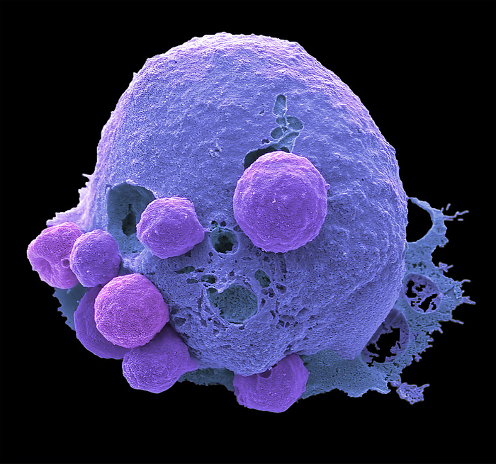 Viral Apoptosis, SEM Viral Apoptosis.Coloured scanning electron micrograph  SEM  of a cultured cancer cell which has become apoptotic after infection with the HIV virus. In addition to inducing immune and inflammatory responses, infection by most viruses triggers apoptosis or programmed cell death of the infected cell. This cell response often results as a compulsory or unavoidable by product of the action of critical viral replicative functions. Characteristics of apoptosis at SEM level are membrane blebs called apoptotic bodies. In culture, apoptotic cells typically undergo further degradation in a process called secondary necrosis seen here as multiple holes in the cell membrane. Magnification: x8000 when printed at 10 centimetres wide. Specimen courtesy of Greg Towers, UCL., by STEVE GSCHMEISSNER SCIENCE PHOTO LIBRARY