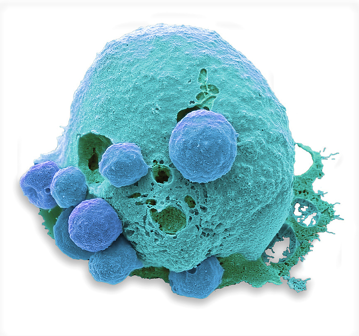 Viral Apoptosis, SEM Viral Apoptosis.Coloured scanning electron micrograph  SEM  of a cultured cancer cell which has become apoptotic after infection with the HIV virus. In addition to inducing immune and inflammatory responses, infection by most viruses triggers apoptosis or programmed cell death of the infected cell. This cell response often results as a compulsory or unavoidable by product of the action of critical viral replicative functions. Characteristics of apoptosis at SEM level are membrane blebs called apoptotic bodies. In culture, apoptotic cells typically undergo further degradation in a process called secondary necrosis seen here as multiple holes in the cell membrane. Magnification: x8000 when printed at 10 centimetres wide. Specimen courtesy of Greg Towers, UCL., by STEVE GSCHMEISSNER SCIENCE PHOTO LIBRARY