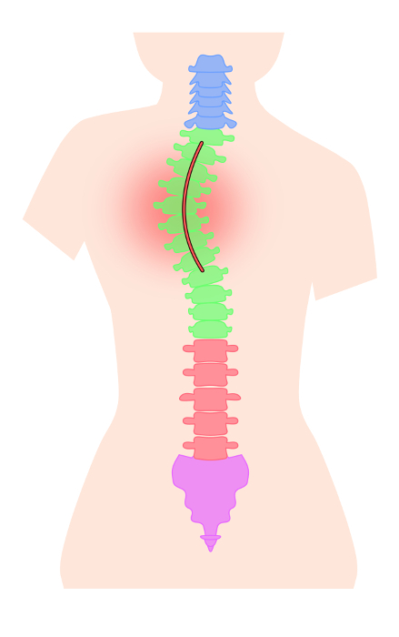 Simple illustration of a scoliosis spine