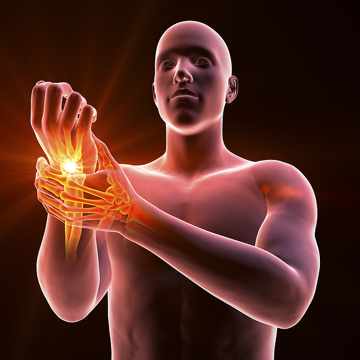 Wrist pain, illustration Man experiencing wrist pain with the skeleton highlighted to show the affected area, illustration., by KATERYNA KON SCIENCE PHOTO LIBRARY