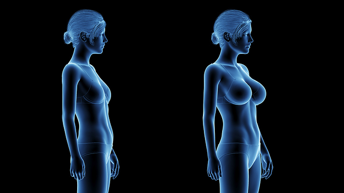Woman after breast enlargement, illustration Woman after breast enlargement, illustration., by SEBASTIAN KAULITZKI SCIENCE PHOTO LIBRARY