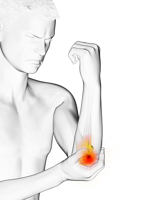 Man with painful elbow, illustration Man with painful elbow, illustration., by SEBASTIAN KAULITZKI SCIENCE PHOTO LIBRARY