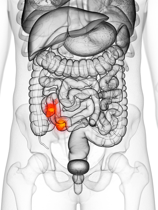 Intestinal cancer, illustration Intestinal cancer, illustration., by SEBASTIAN KAULITZKI SCIENCE PHOTO LIBRARY