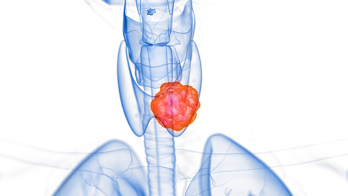 Thyroid tumour, illustration Thyroid tumour, illustration., by SEBASTIAN KAULITZKI SCIENCE PHOTO LIBRARY
