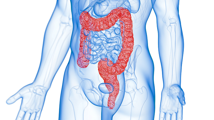 Inflamed colon, illustration Inflamed colon, illustration., by SEBASTIAN KAULITZKI SCIENCE PHOTO LIBRARY