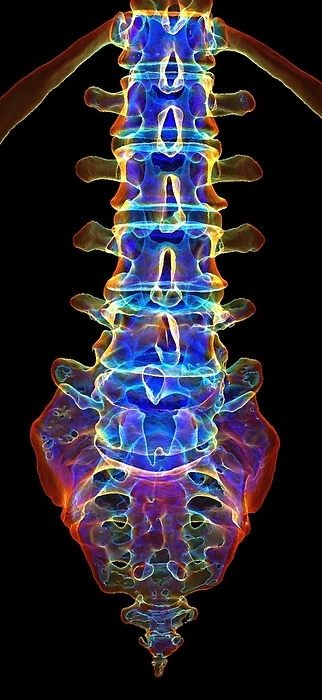 Lumbar and sacral spine, 3D CT scan Coloured 3D computed tomography  CT  scan of the lumbar and sacral spine. The lumbar spine is made up of five vertebrae  cylindrical individual bones of the spine  known as L1 to L5, although it is not unusual to have six. This part of the spine bears most of the body s weight and allows for the most movement, which can lead to back problems. The sacral region, located beneath the lumbar spine, is composed of five bony sections called S1 to S5. These sections fuse together to form the triangular shaped bone that serves as the base of the spine and contributes to the pelvis. At the very bottom of the spine lies the coccyx, which is made up of four small bones and is commonly known as the tailbone. Both the sacrum and the coccyx play a crucial role in walking, running, and sitting., by K H FUNG SCIENCE PHOTO LIBRARY