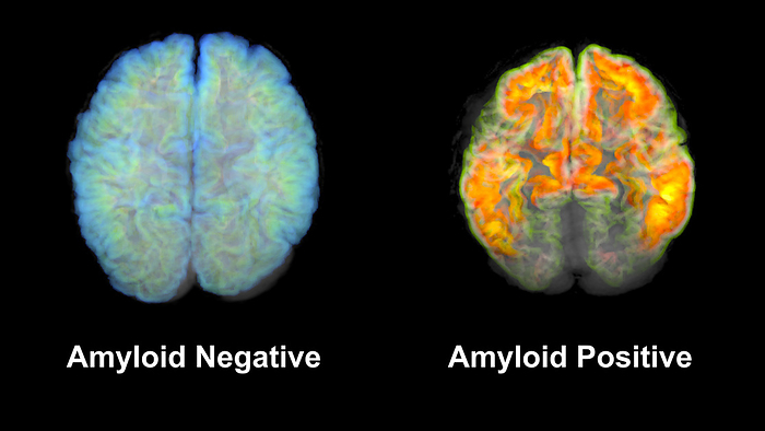 Healthy brain and brain with amyloid plaques, MRI scans Coloured magnetic resonance imaging  MRI  scans of a healthy brain  left  and a brain with extracellular amyloid plaque deposits  right . Amyloid plaques are insoluble aggregates of beta amyloid protein. They are believed to be linked to Alzheimer s disease by causing nerve cell death and affecting nerve cell signalling pathways., by MARK AND MARY STEVENS NEUROIMAGING AND INFORMATICS INSTITUTE SCIENCE PHOTO LIBRARY