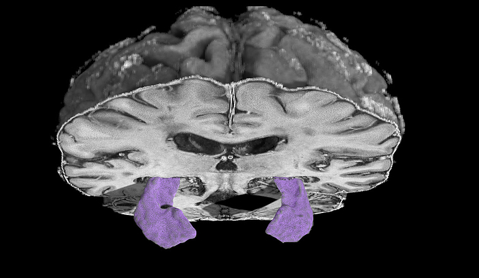 Atrophied hippocampi, MRI scan Coloured 3D magnetic resonance imaging  MRI  scan of a brain with atrophied  shrunken  hippocampi  purple . The hippocampus is responsible for long term memory. It can become atrophied in neurodegenerative diseases such as Alzheimer s disease., by MARK AND MARY STEVENS NEUROIMAGING AND INFORMATICS INSTITUTE SCIENCE PHOTO LIBRARY