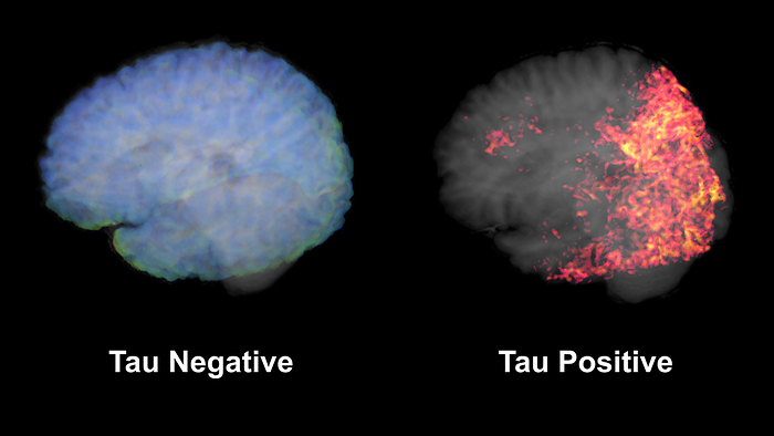 Healthy brain and brain with tau aggregations, MRI scans Coloured magnetic resonance imaging  MRI  scans of a healthy brain  left  and a brain with aggregations of tau protein  right . Tau protein is an abundant neural protein, aggregations of which are thought to play a role in Alzheimer s disease and other neural disorders., by MARK AND MARY STEVENS NEUROIMAGING AND INFORMATICS INSTITUTE SCIENCE PHOTO LIBRARY