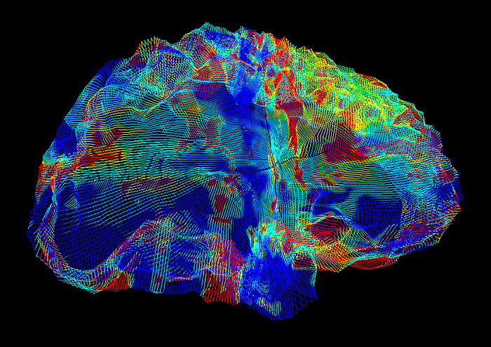 Brain in Alzheimer s disease, DTI MRI scan Coloured diffusion tensor imaging  DTI  magnetic resonance imaging  MRI  scan showing white matter fibres in the brain of a patient with Alzheimer s disease. Alzheimer s is a neurodegenerative disease where atrophy  shrinking  of the brain leads to memory loss, confusion, personality changes and ultimately death. Diffusion tensor imaging measures the direction of water diffusion, which in the brain reveals the orientation of nerve fibres. Red fibres have a left to right orientation, green a front to back orientation and blue an up and down orientation., by MARK AND MARY STEVENS NEUROIMAGING AND INFORMATICS INSTITUTE SCIENCE PHOTO LIBRARY