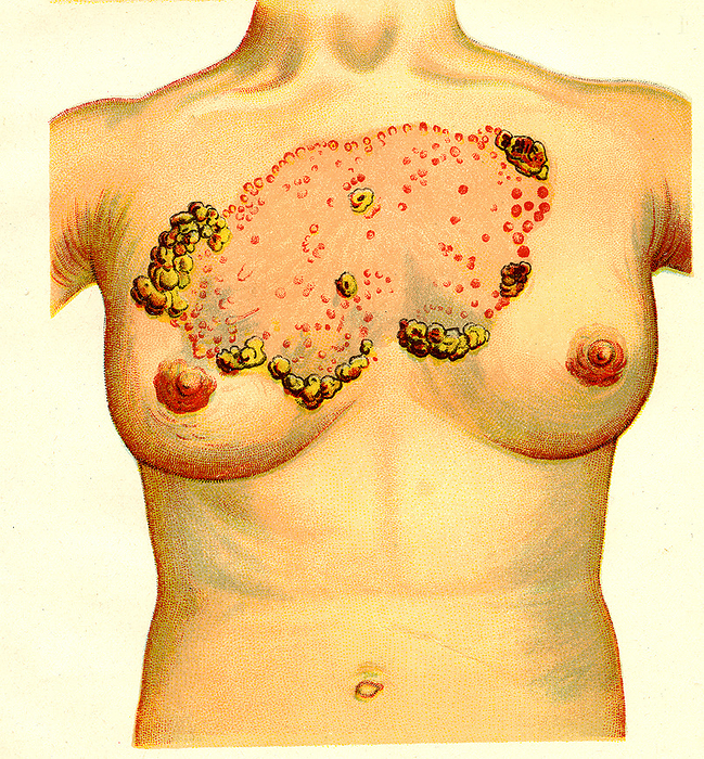 Lupus erythematosus, illustration Illustration of lupus erythematosus  LE  affecting a patient s chest. LE is an autoimmune disease that can affect any part of the body, but most often affects the heart, joints and skin. There is no cure and treatment is aimed at reducing inflammation and pain. Illustration from Mon Docteur by Dr H M Menier  1907 ., by COLLECTION ABECASIS SCIENCE PHOTO LIBRARY