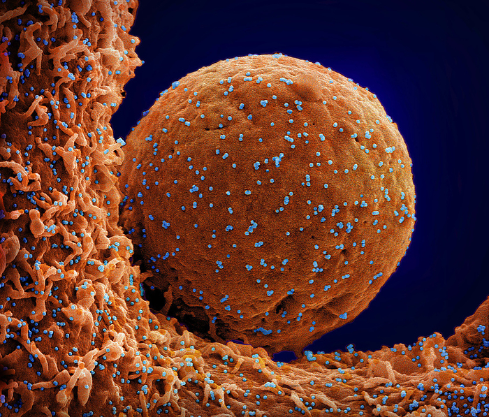 Cell infected by SARS CoV 2 virus particles, SEM Coloured scanning electron micrograph  SEM  of a cell  orange  infected with the Omicron strain of the SARS CoV 2 virus particles  blue  from a US patient sample. SARS CoV 2 causes the respiratory infection Covid 19, which can lead to fatal pneumonia., by NIAID NATIONAL INSTITUTES OF HEALTH SCIENCE PHOTO LIBRARY