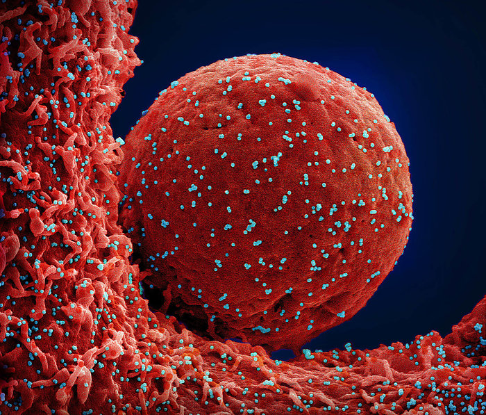 Cell infected by SARS CoV 2 virus particles, SEM Coloured scanning electron micrograph  SEM  of a cell  red  infected with the Omicron strain of the SARS CoV 2 virus particles  blue  from a US patient sample. SARS CoV 2 causes the respiratory infection Covid 19, which can lead to fatal pneumonia., by NIAID NATIONAL INSTITUTES OF HEALTH SCIENCE PHOTO LIBRARY