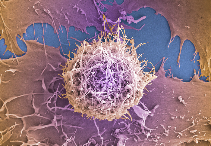 Cervical cancer cells, SEM Cervical cancer cells, colored scanning electron micrograph  SEM . The cervix is the lower part of the womb, also called the neck of the womb and comprises part of the woman   reproductive system. Cervical cancer is more common in younger women and one of the main causes is a persistent infection of certain types of the human papilloma virus  HPV . Magnification: x3200 when printed at 10cm wide. by ANNE E. WESTON SCIENCE PHOTO LIBRARY