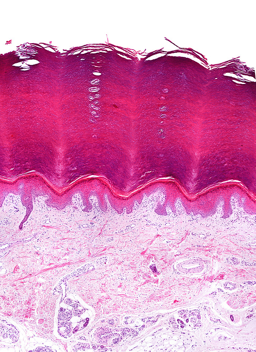 Skin on sole of the foot, light micrograph Light micrograph of human glabrous skin. At top, the epidermis, a keratinised stratified squamous epithelium is showing a prominent horny layer with two acrosyringia, the excretory ducts of eccrine sweat glands. At bottom, the dermis shows eccrine sweat glands. Haematoxylin and eosin stain., by JOSE CALVO   SCIENCE PHOTO LIBRARY