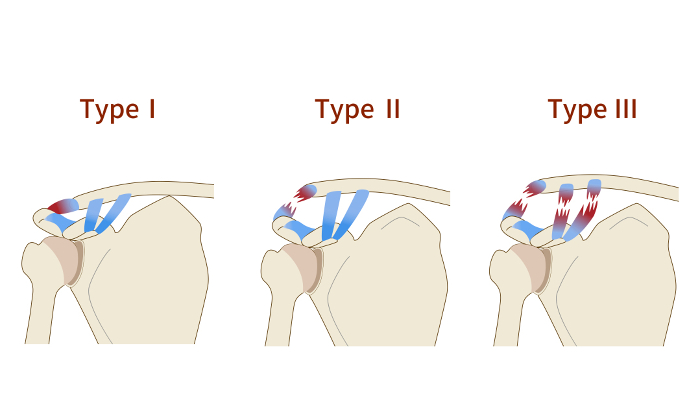 Three stages of acromioclavicular joint dislocation