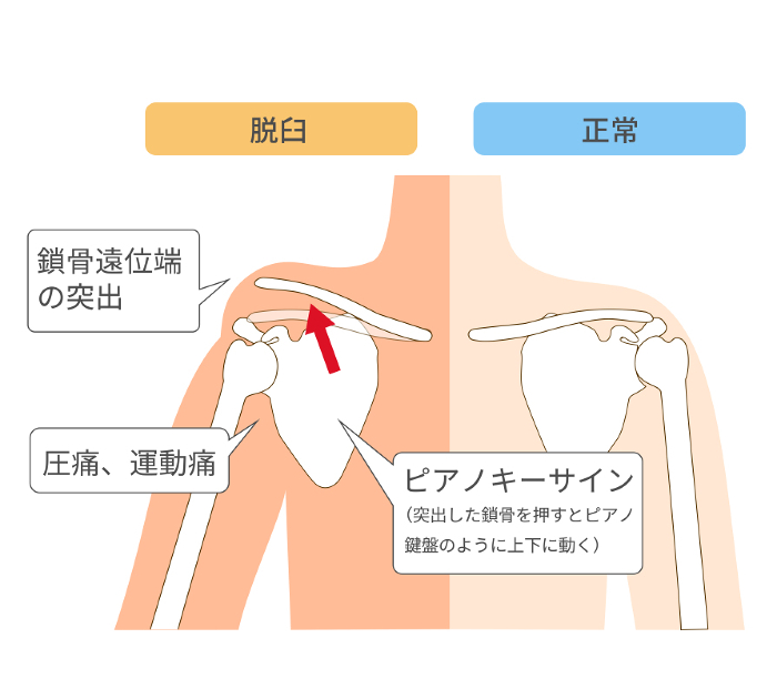 Characteristics and Comparative Diagram of Acromioclavicular Joint Dislocation