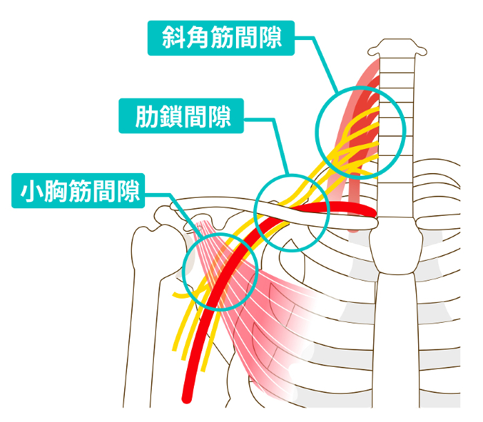 Three gaps that cause thoracic outlet syndrome