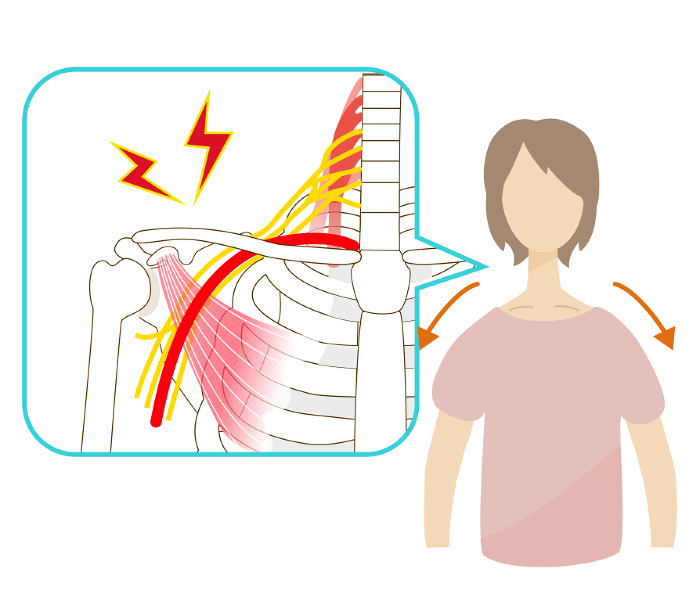 A woman with a slumped shoulder suffering from thoracic outlet syndrome pain
