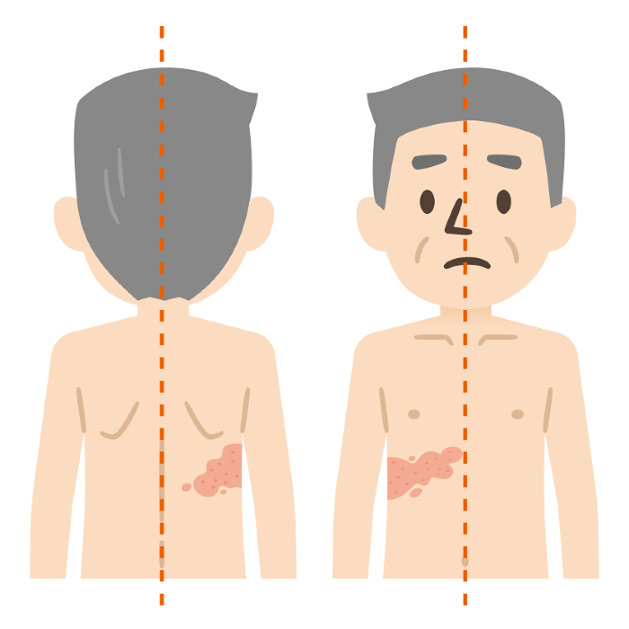 Illustration of Shingles Symptoms