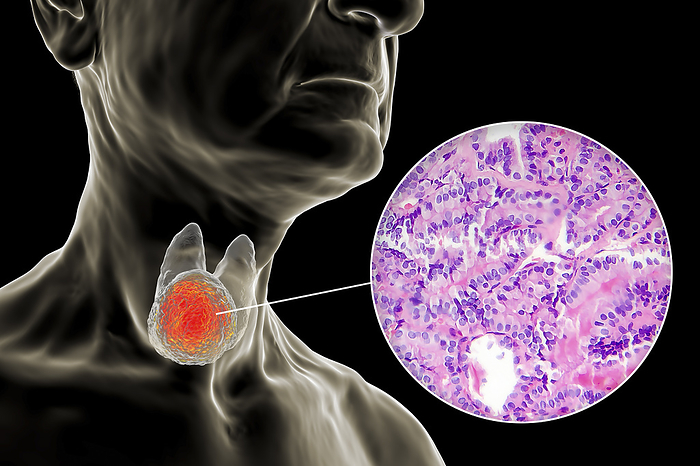 Thyroid cancer, illustration Illustration showing a human body with a tumour in the thyroid gland, along with a light micrograph of papillary thyroid carcinoma., by KATERYNA KON SCIENCE PHOTO LIBRARY