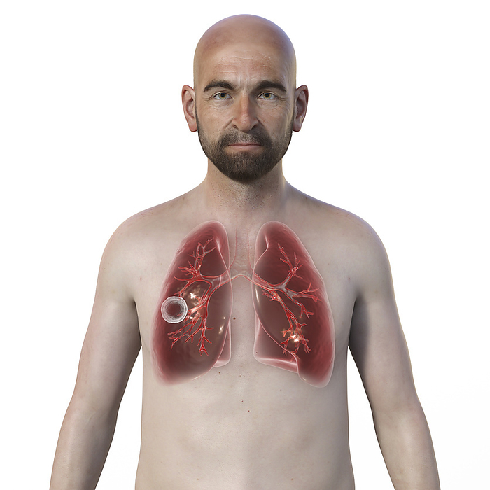Cavernous tuberculosis, illustration Man with transparent skin, showcasing the lungs affected by cavernous tuberculosis., by KATERYNA KON SCIENCE PHOTO LIBRARY