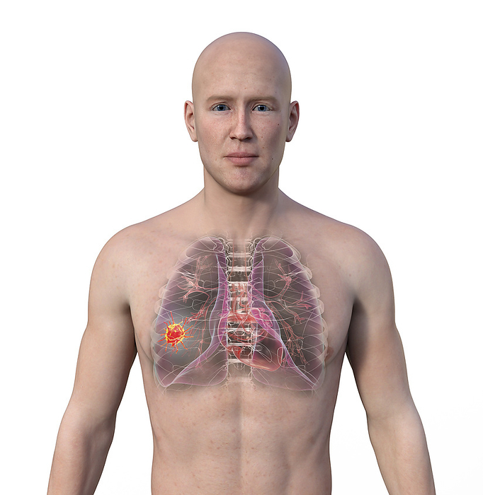 Lung cancer, illustration Man with transparent skin, revealing the presence of lung cancer., by KATERYNA KON SCIENCE PHOTO LIBRARY