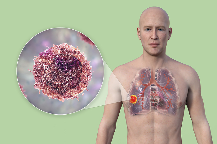 Lung cancer, illustration Man with transparent skin, revealing the presence of lung cancer, and close up view of cancer cells., by KATERYNA KON SCIENCE PHOTO LIBRARY
