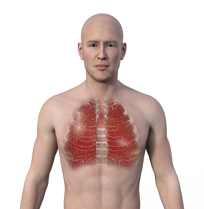 Lungs affected by miliary tuberculosis, illustration Man with transparent skin, revealing the lungs affected by miliary tuberculosis., by KATERYNA KON SCIENCE PHOTO LIBRARY