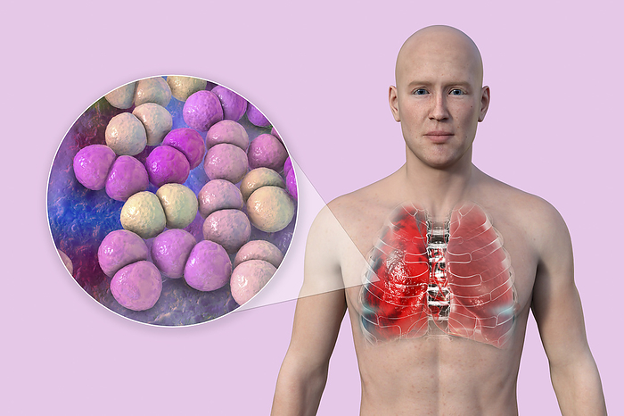 Lungs affected by pneumonia, illustration Man with transparent skin, revealing the lungs affected by pneumonia, and close up view of Streptococcus pneumoniae bacteria., by KATERYNA KON SCIENCE PHOTO LIBRARY